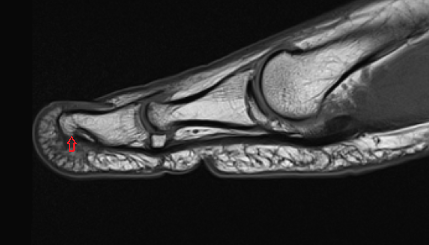Tuberosity of Distal Phalanx of Foot  mri  anatomy labelled image-img-00000-00000