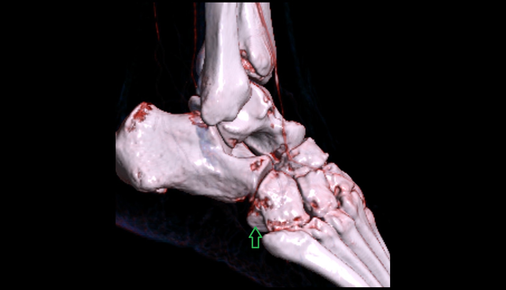 Tuberosity of cuboid bone