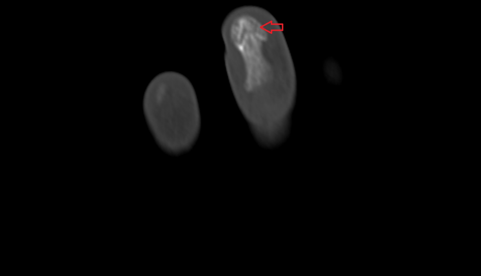 Tuberosity of distal phalanx ct coronal