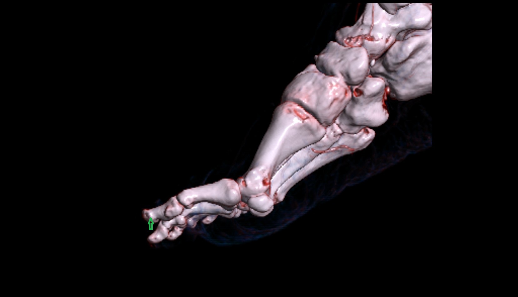 Tuberosity of distal phalanx of great toe 3d