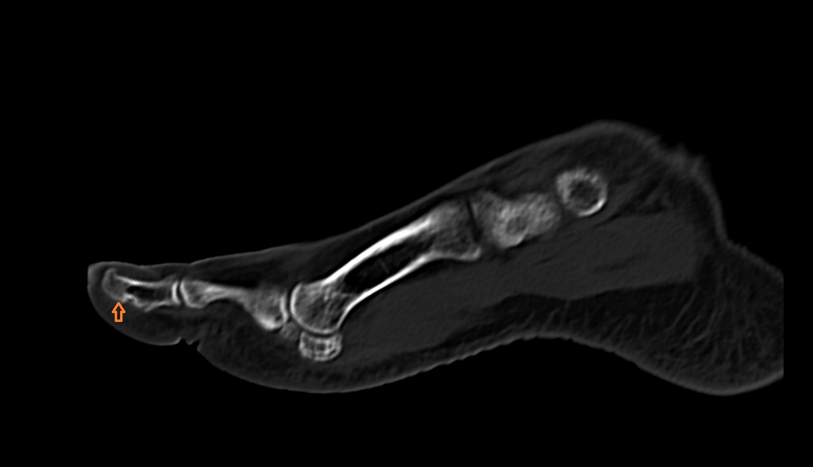 Tuberosity of distal phalanx of great toe ct