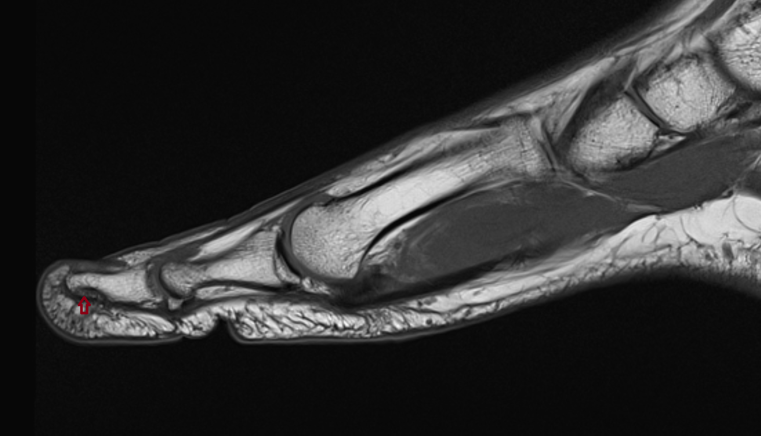Tuberosity of distal phalanx of great toe mri  anatomy labelled image-img-00000-00000
