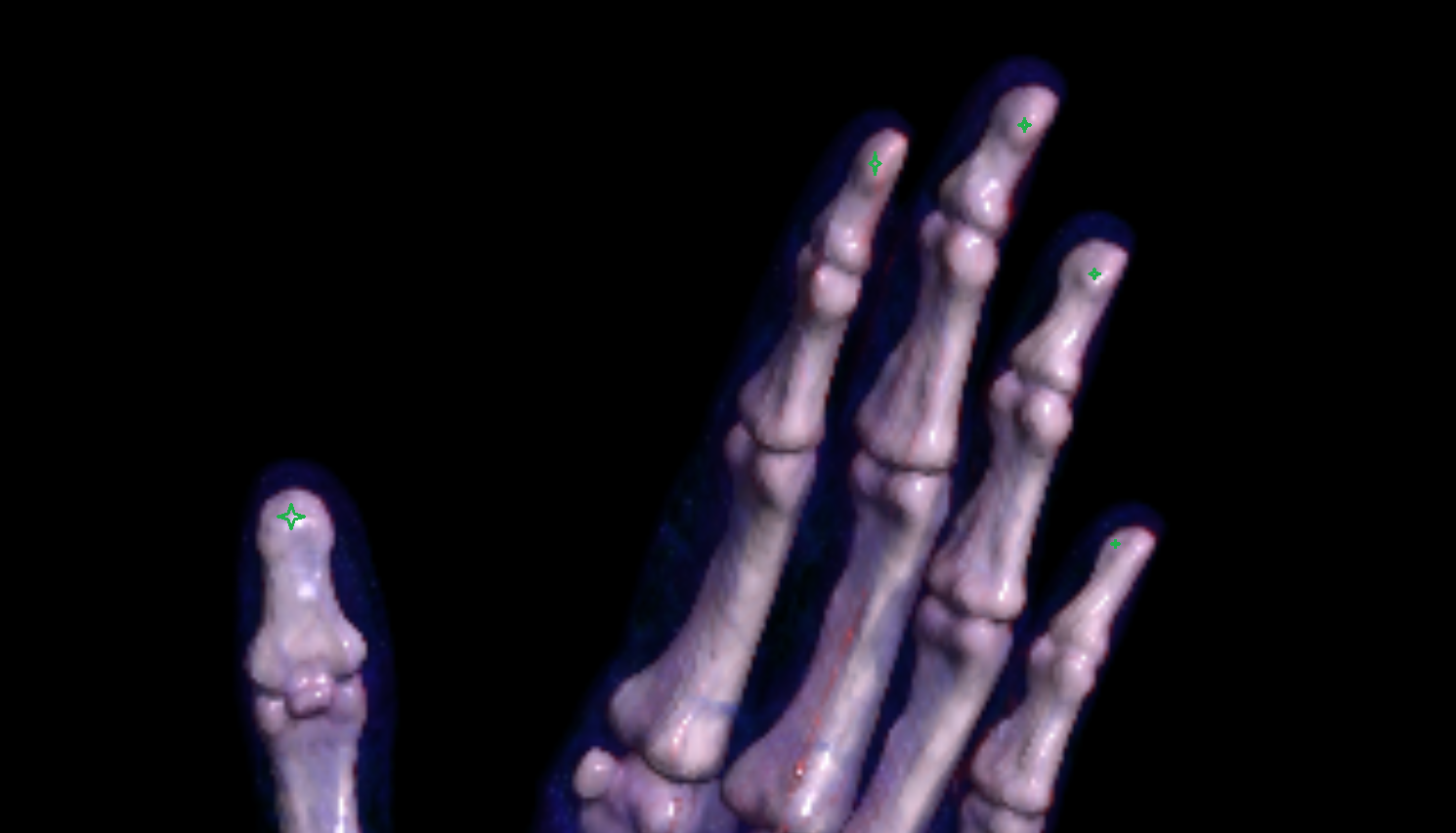 Tuberosity of distal phalanx of hand 3D VRT  CT image -img-00000-00000