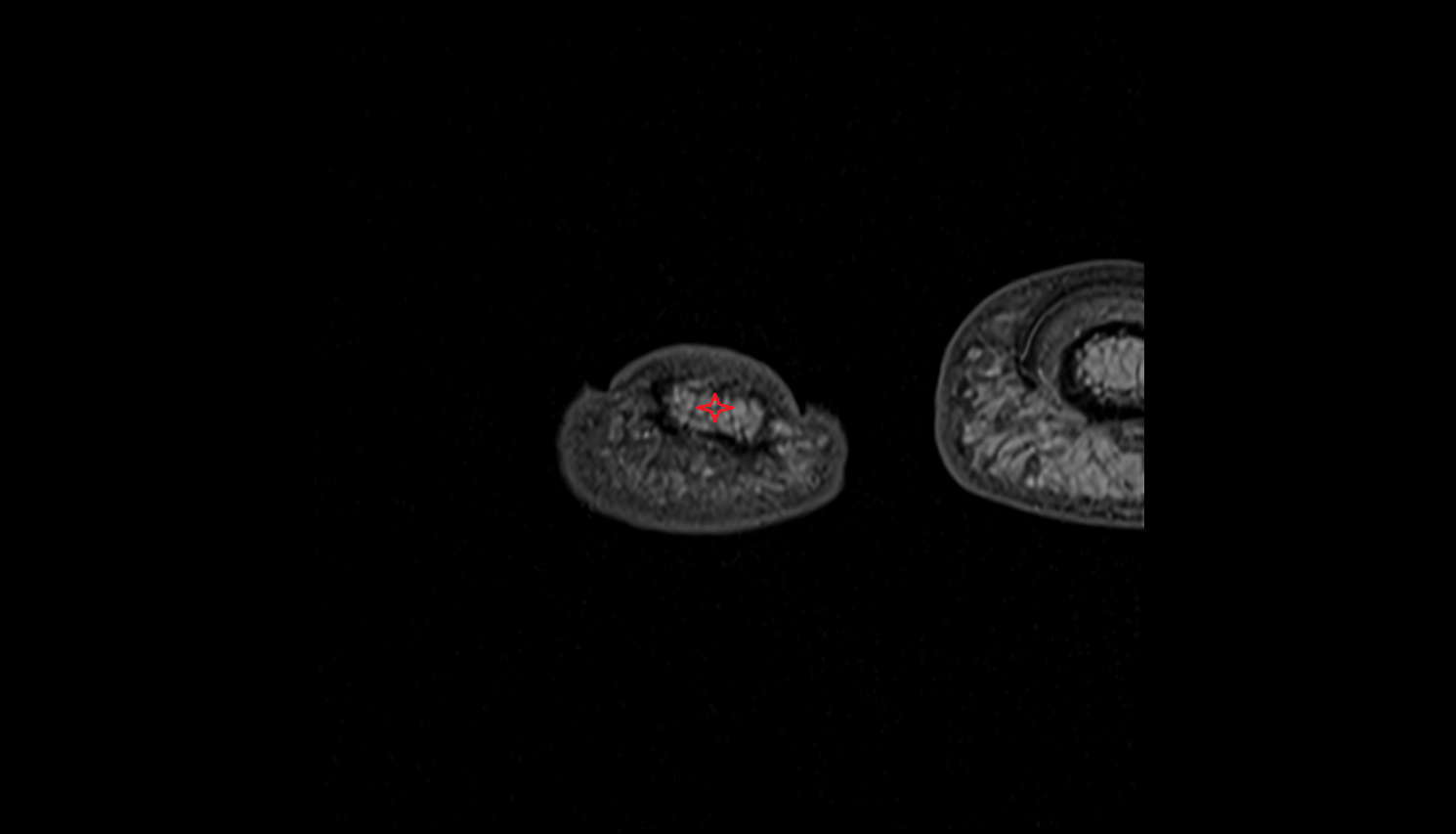 Tuberosity of distal phalanx of hand  axial cross sectional anatomy 3T MRI AI enhanced radiology image-img-00000-00000_00001