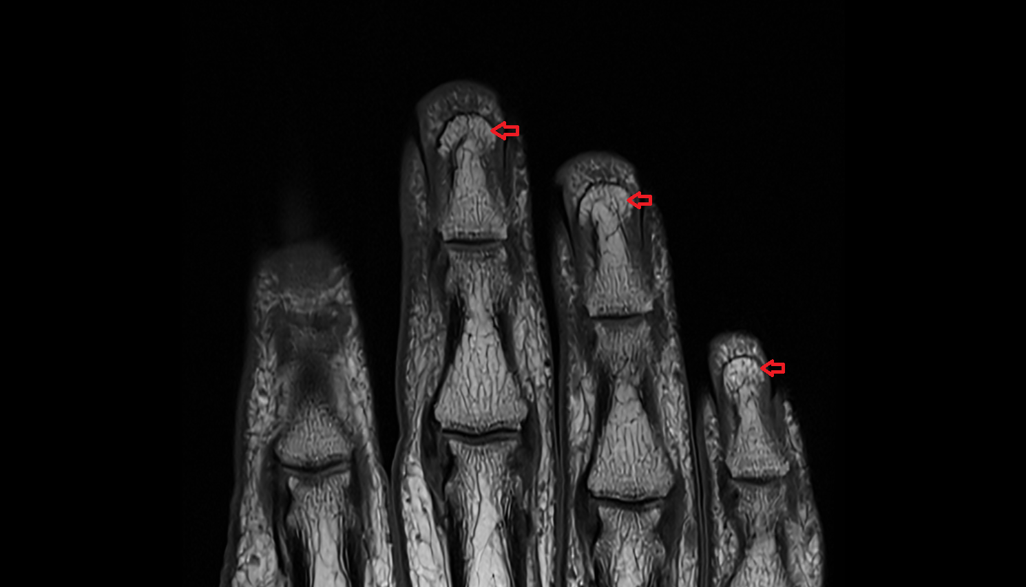 Tuberosity of distal phalanx of hand  coronal cross sectional anatomy 3T MRI AI enhanced radiology image-img-00000-00000