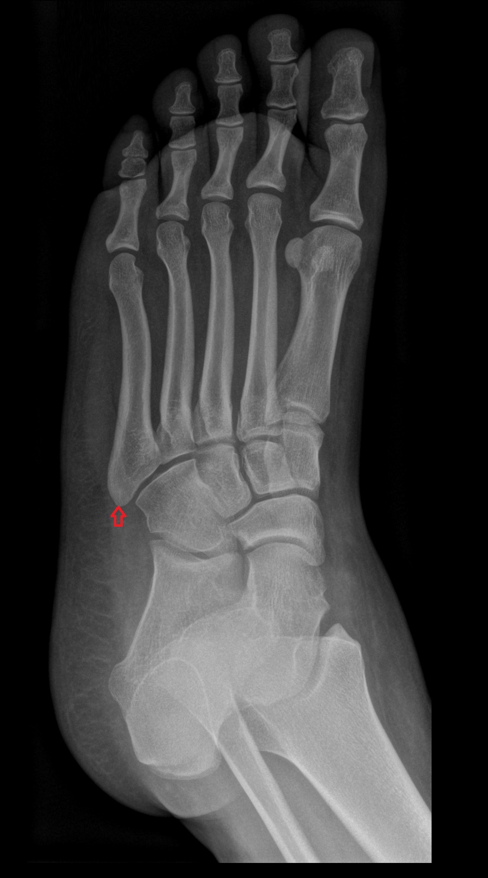 Tuberosity of fifth metatarsal bone