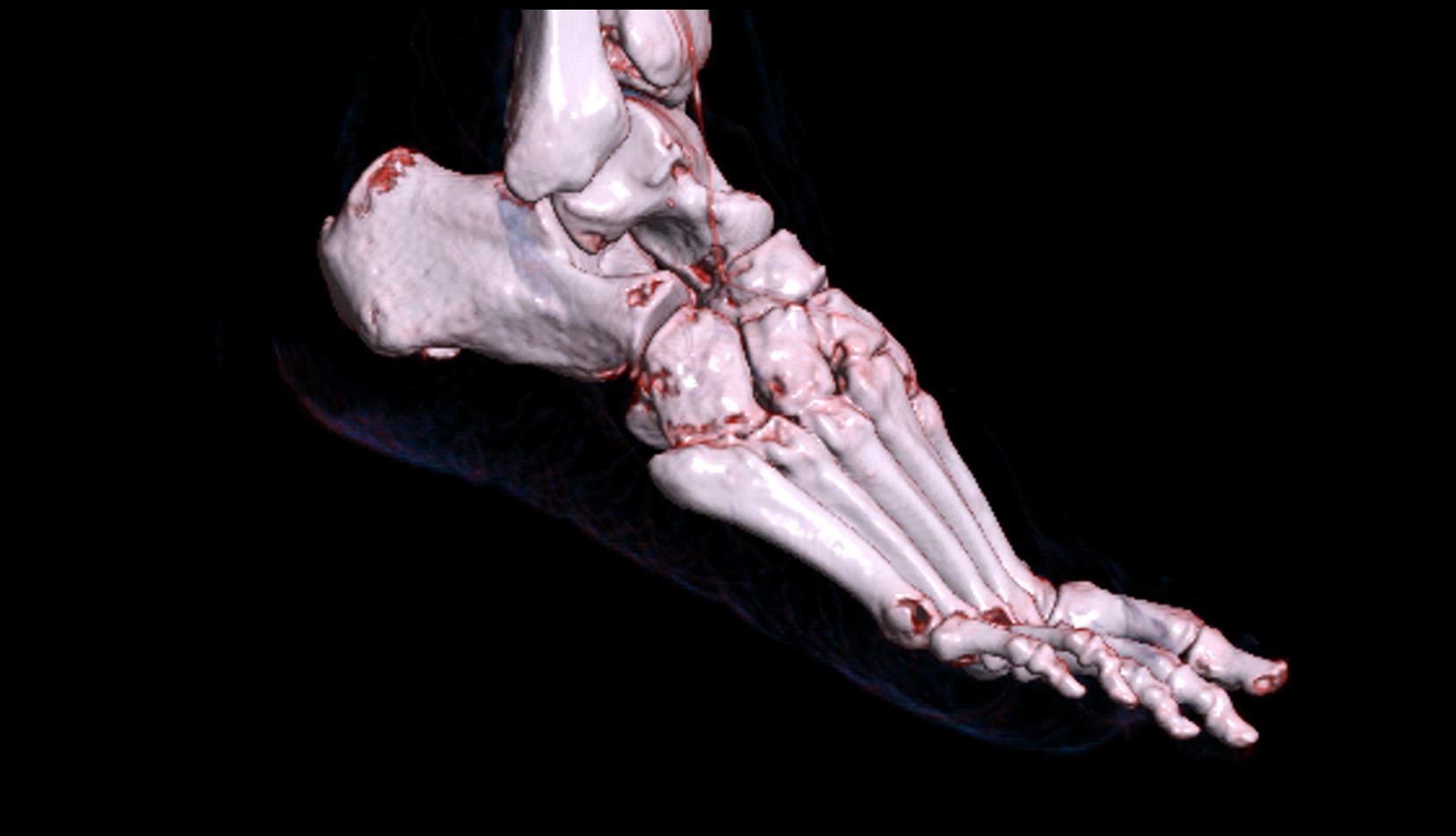 Tuberosity of fifth metatarsal bone 3d