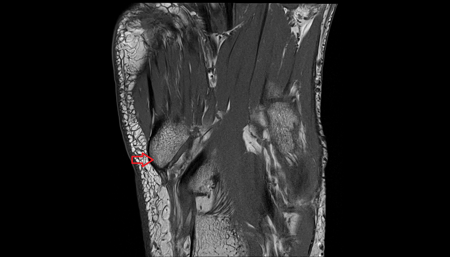 Tuberosity of fifth metatarsal bone  mri  anatomy labelled image-img-00000-00000
