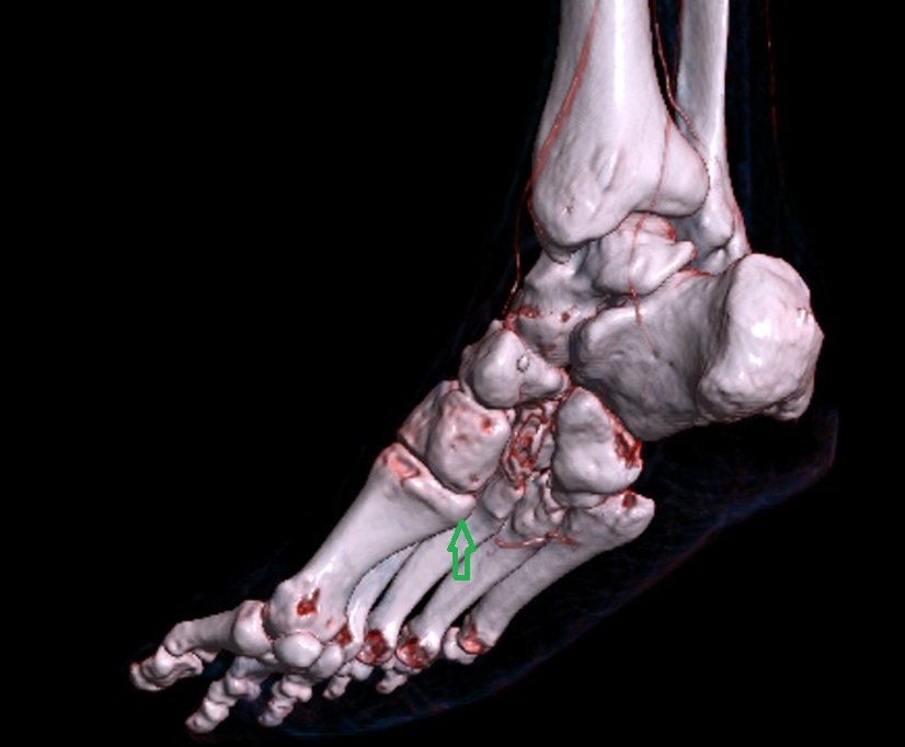 Tuberosity of first metatarsal bone 3d