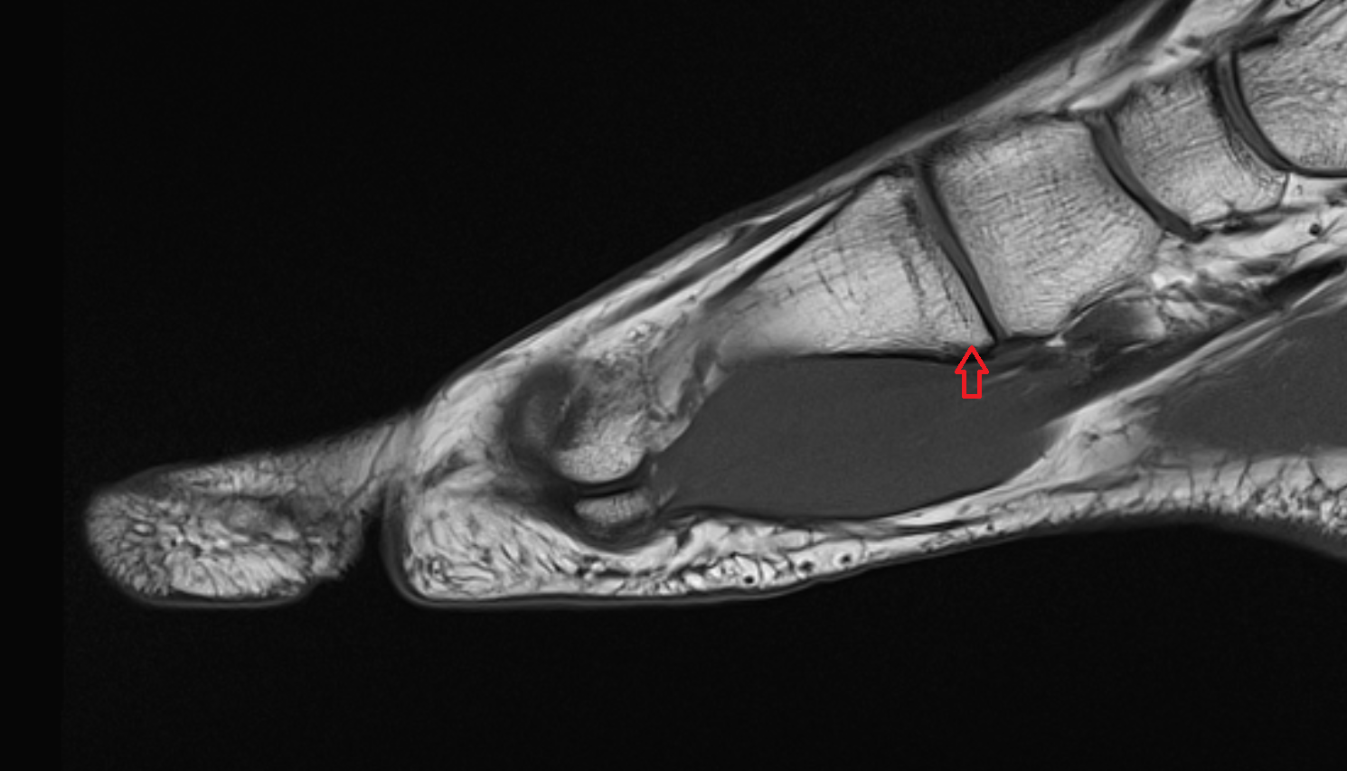 Tuberosity of first metatarsal bone  mri  anatomy labelled image-img-00000-00000