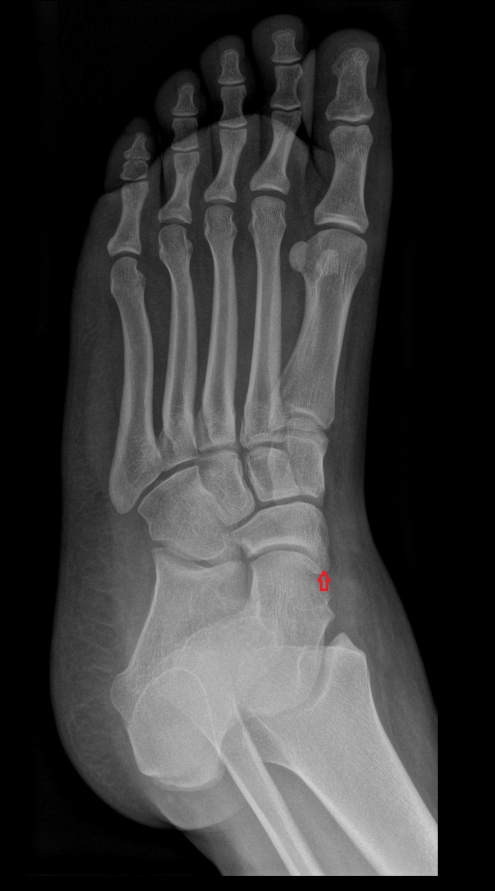 Tuberosity of navicular bone