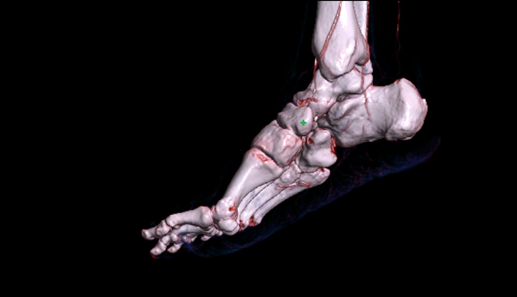 Tuberosity of navicular bone 3d