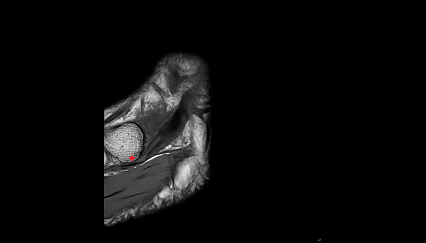 Tuberosity of navicular bone MRI sagl  cross sectional anatomy 3T MRI AI enhanced radiology image-img-00000-00000