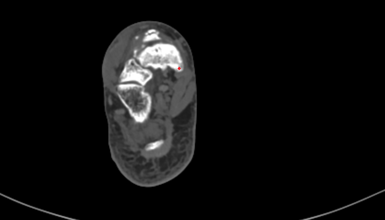 Tuberosity of navicular bone axial  CT cross sectional anatomy radiology image-img-00000-00000