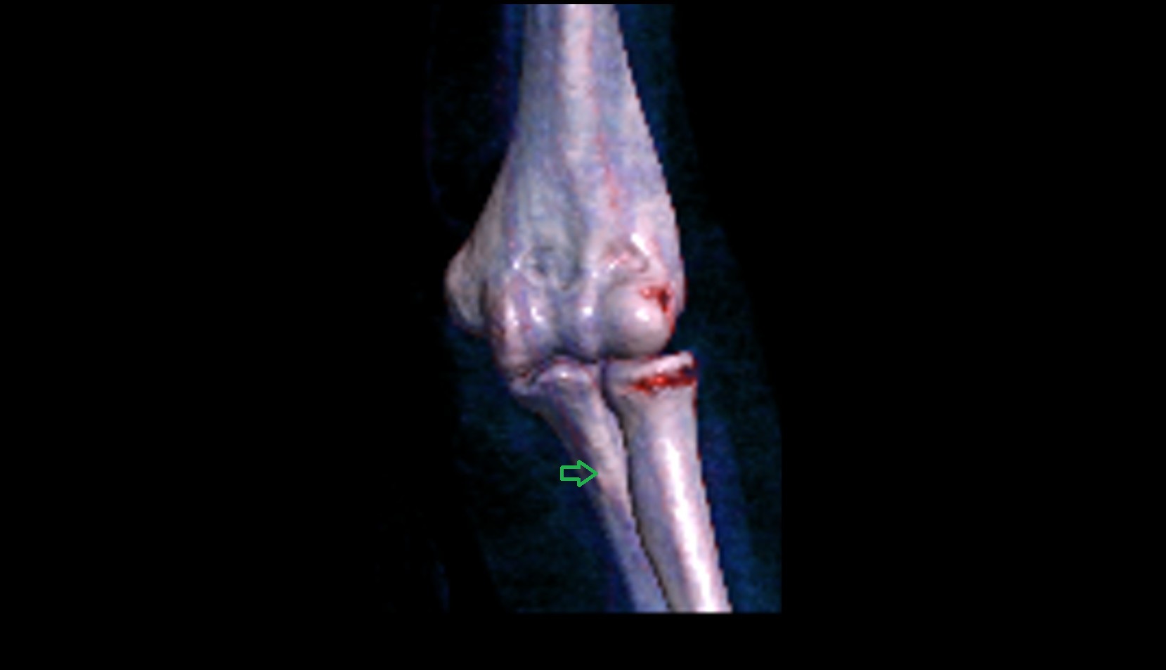 Tuberosity of ulna 3d