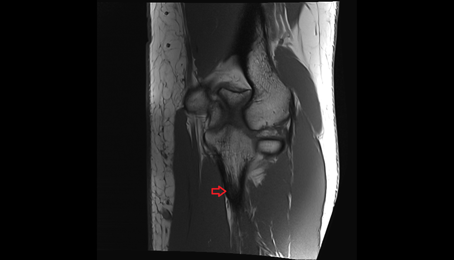 Tuberosity of ulna mri  anatomy labelled image-img-00000-00000