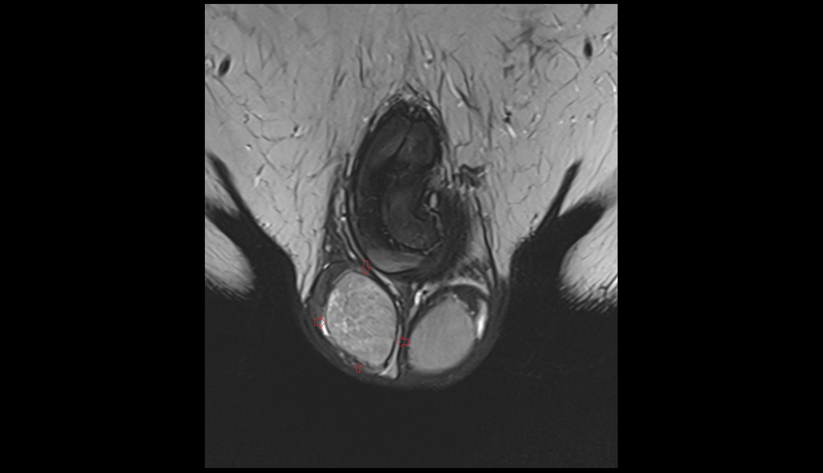 Tunica albuginea of testis mri coronal