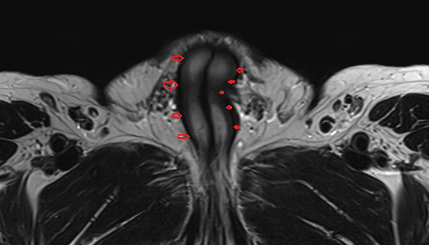 Tunica albuginea (penis)  mri axial  anatomy  image-img-00000-00000_00001