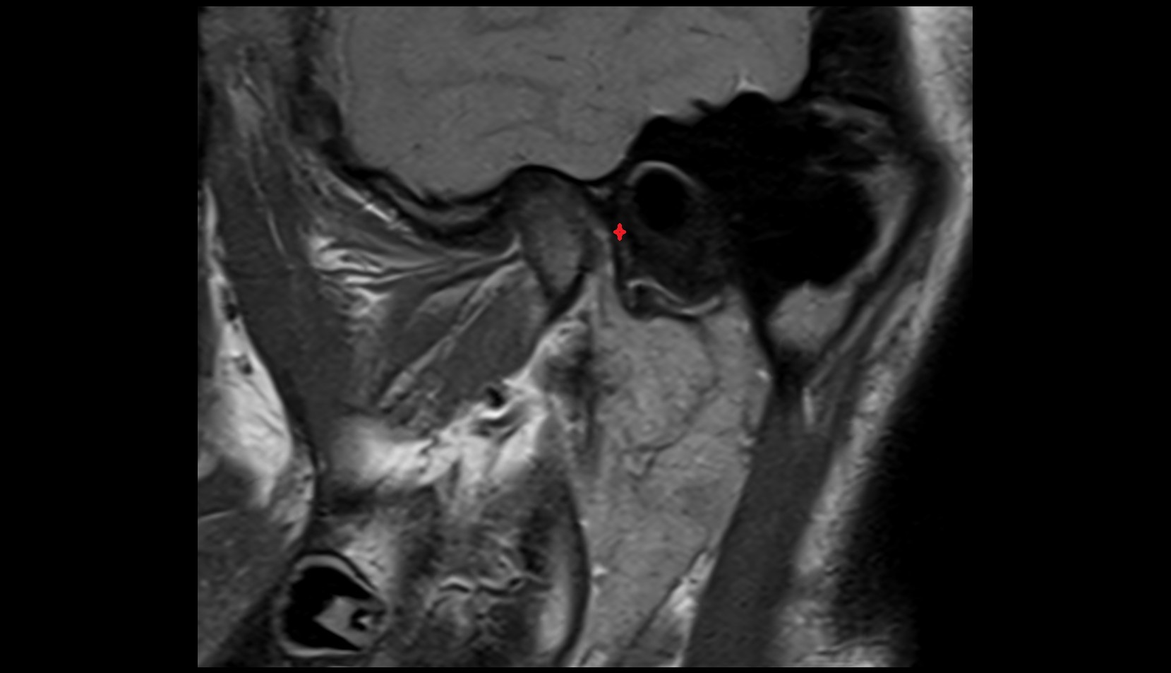 Tympanic part of temporal bone mri