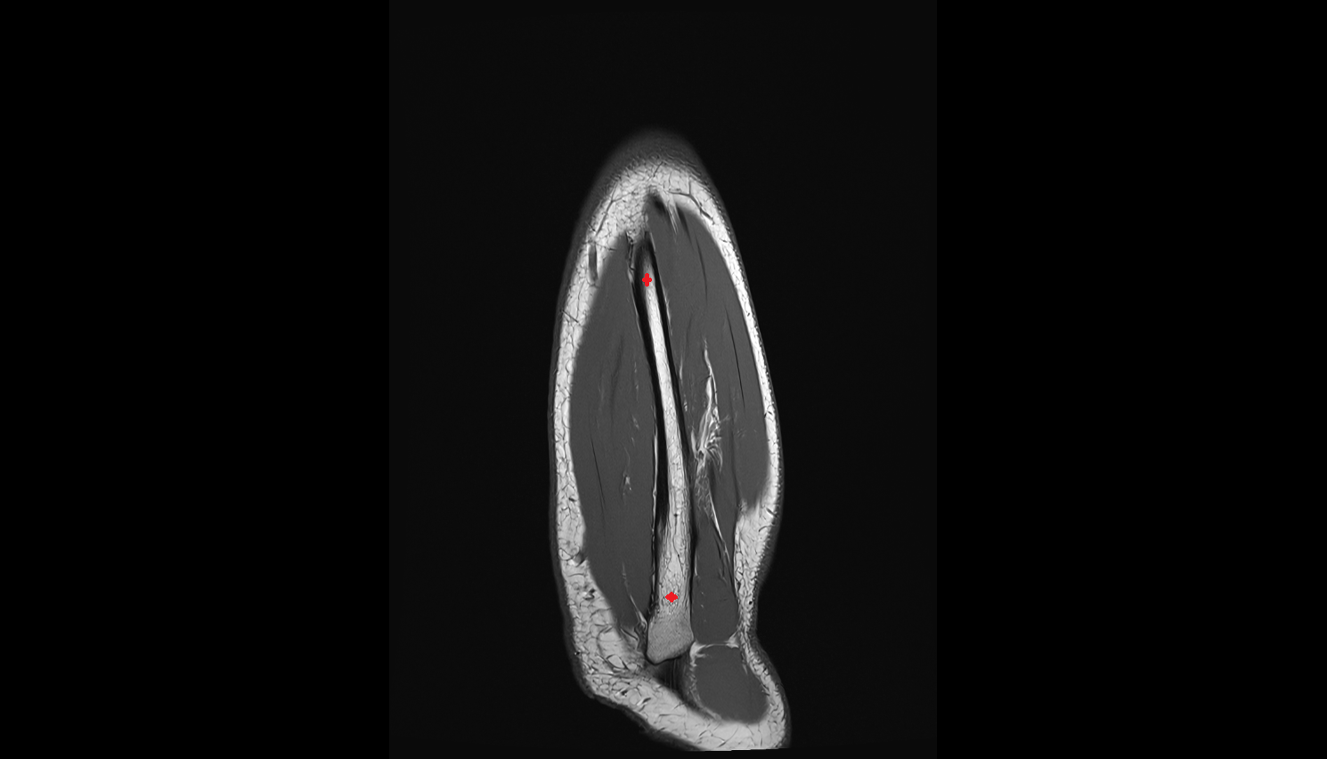 Ulna bone coronal cross sectional anatomy 3T MRI AI enhanced radiology image -img-00000-00000_00001