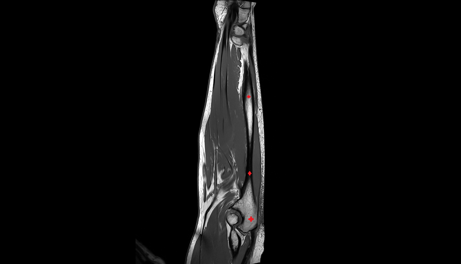 Ulna bone sagcross sectional anatomy 3T MRI AI enhanced radiology image -img-00000-00000