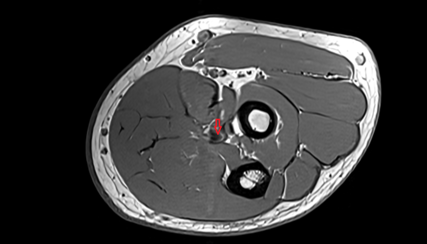 Ulnar artery axial cross sectional anatomy 3T MRI AI enhanced radiology image -img-00000-00000