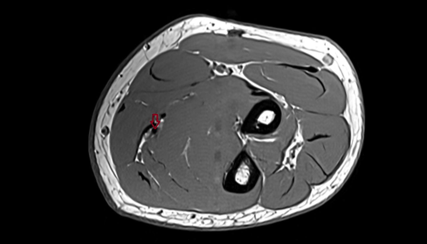 Ulnar artery axial cross sectional anatomy 3T MRI AI enhanced radiology image -img-00000-00000_00001