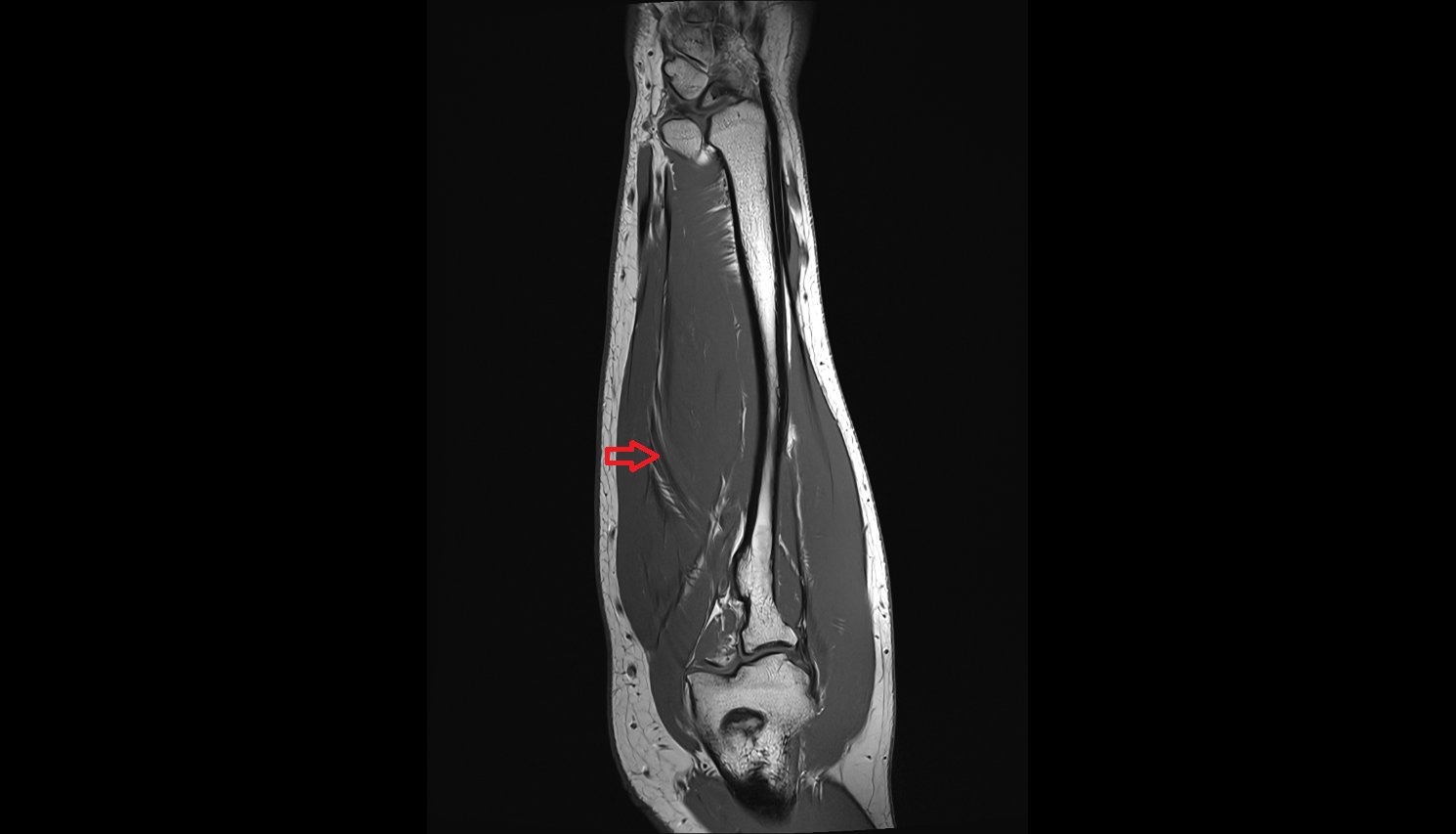 Ulnar artery coronal cross sectional anatomy 3T MRI AI enhanced radiology image -img-00000-00000