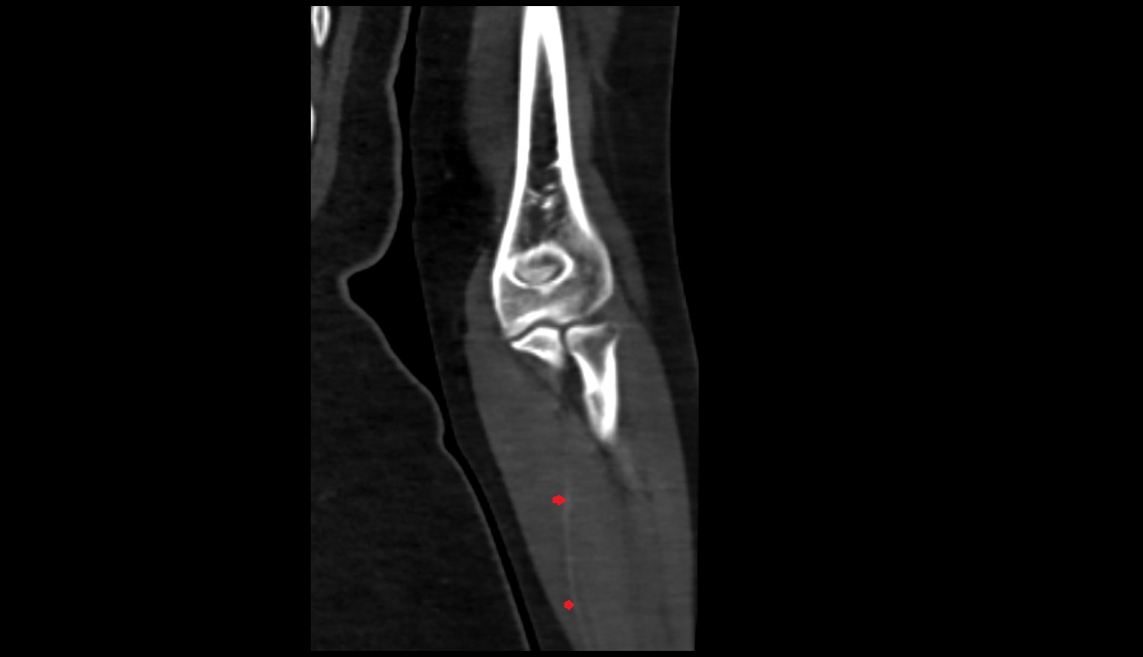 Ulnar artery ct coronal