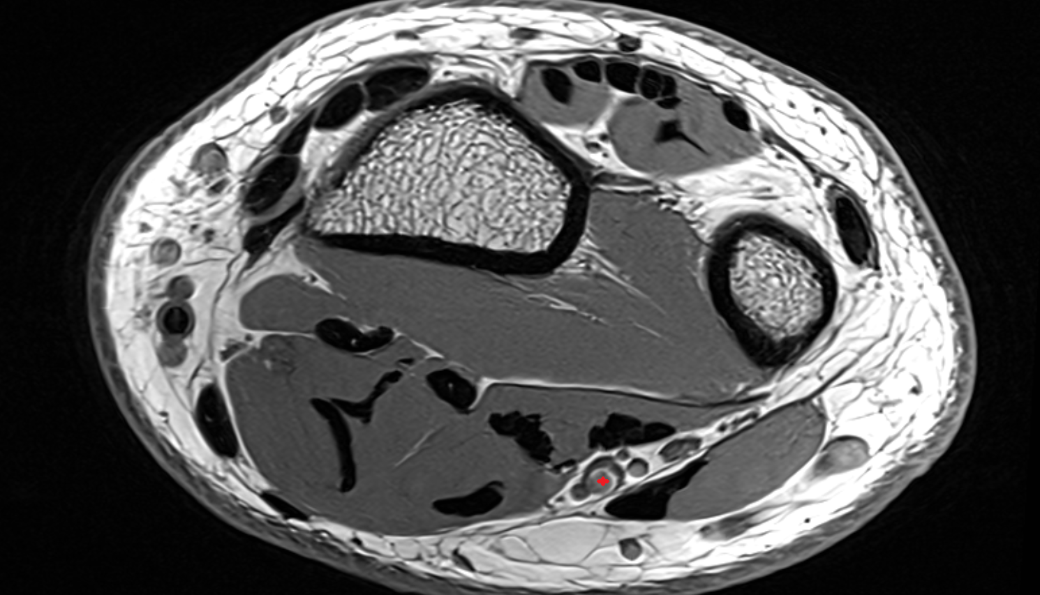Ulnar artery wrist axial cross sectional anatomy 3T MRI AI enhanced radiology image-img-00000-00000