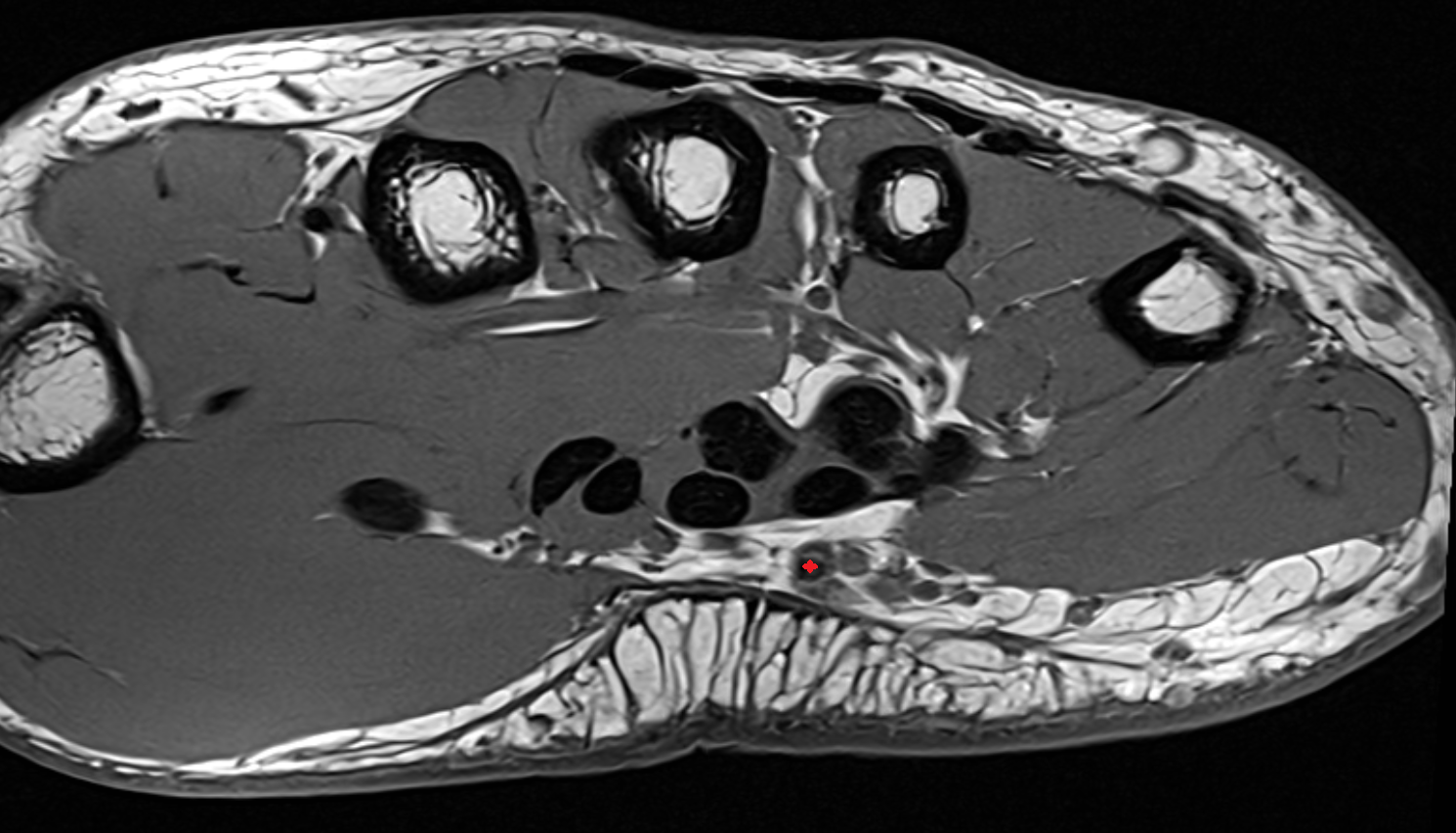 Ulnar artery wrist axial cross sectional anatomy 3T MRI AI enhanced radiology image-img-00000-00000_00001