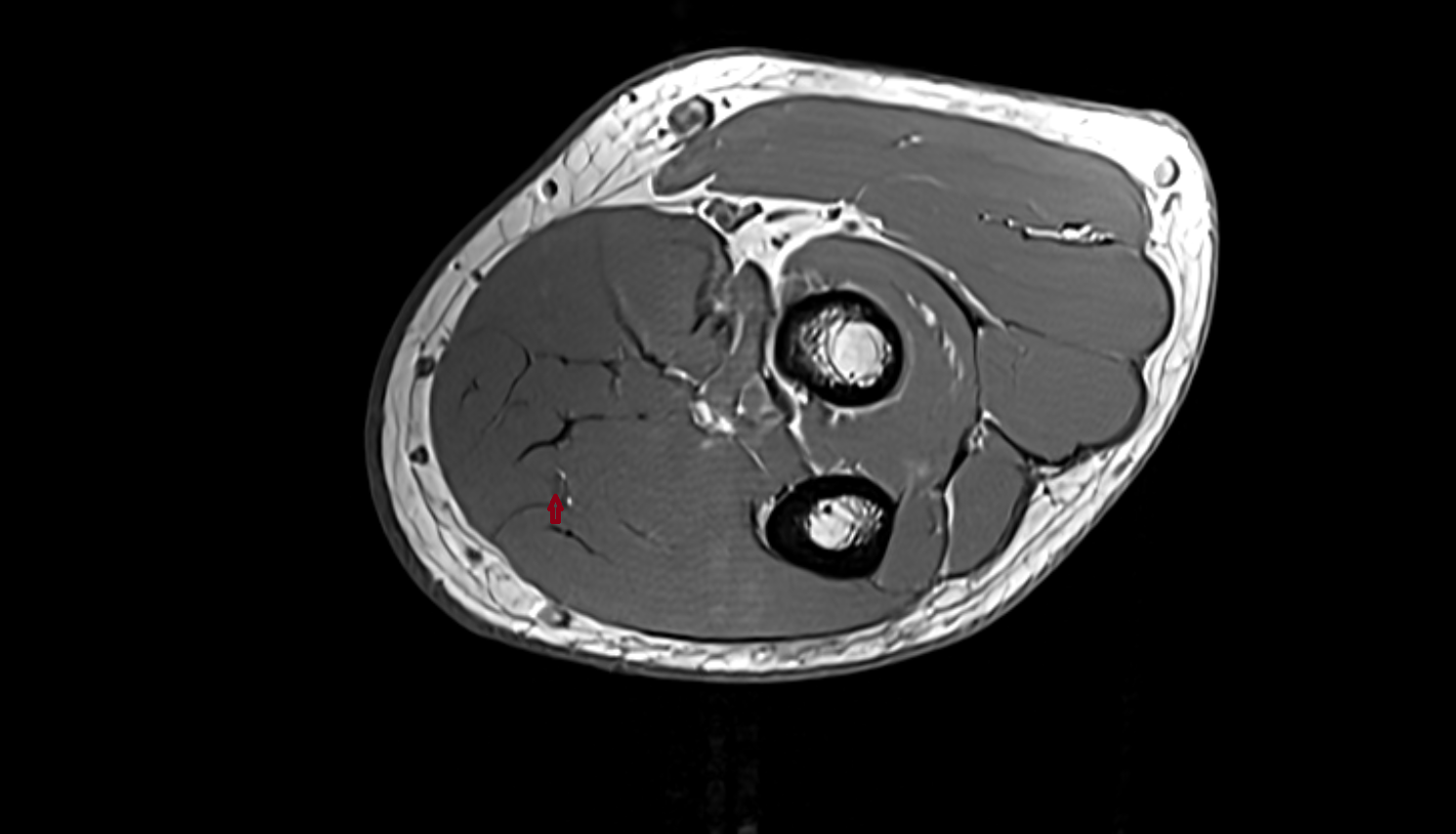Ulnar nerve  axial cross sectional anatomy 3T MRI AI enhanced radiology image -img-00000-00000_00001