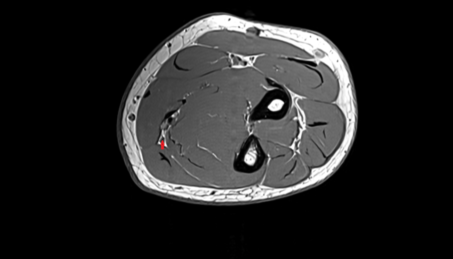 Ulnar nerve  axial cross sectional anatomy 3T MRI AI enhanced radiology image -img-00000-00000_00002