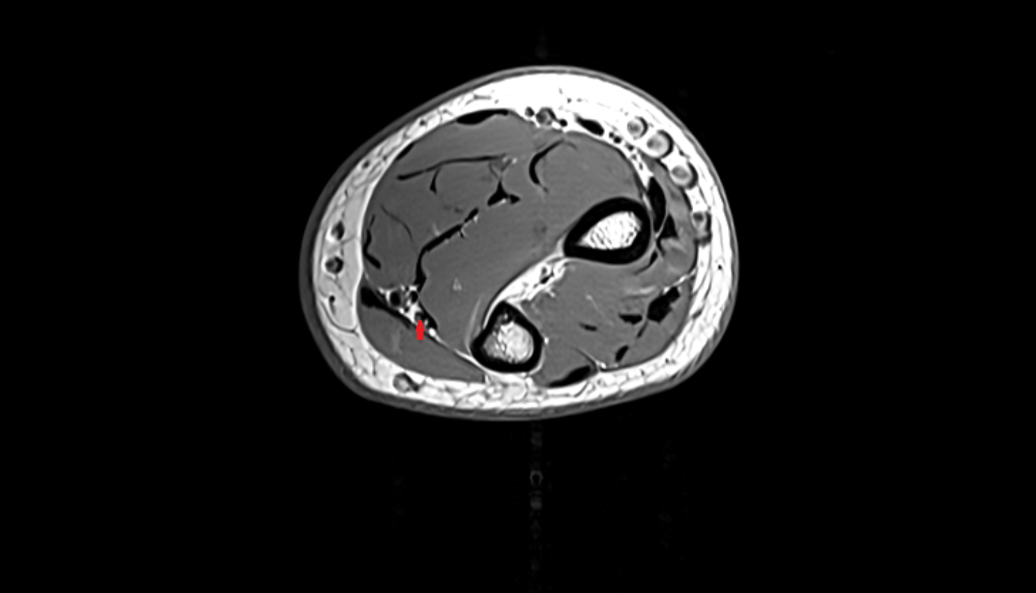 Ulnar nerve  axial cross sectional anatomy 3T MRI AI enhanced radiology image -img-00000-00000_00003