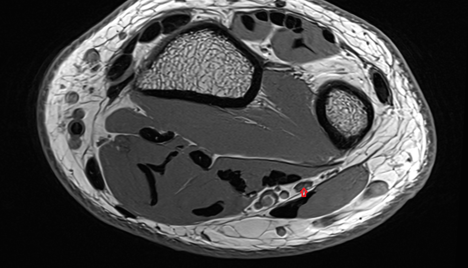Ulnar nerve axial wrist cross sectional anatomy 3T MRI AI enhanced radiology image-img-00000-00000