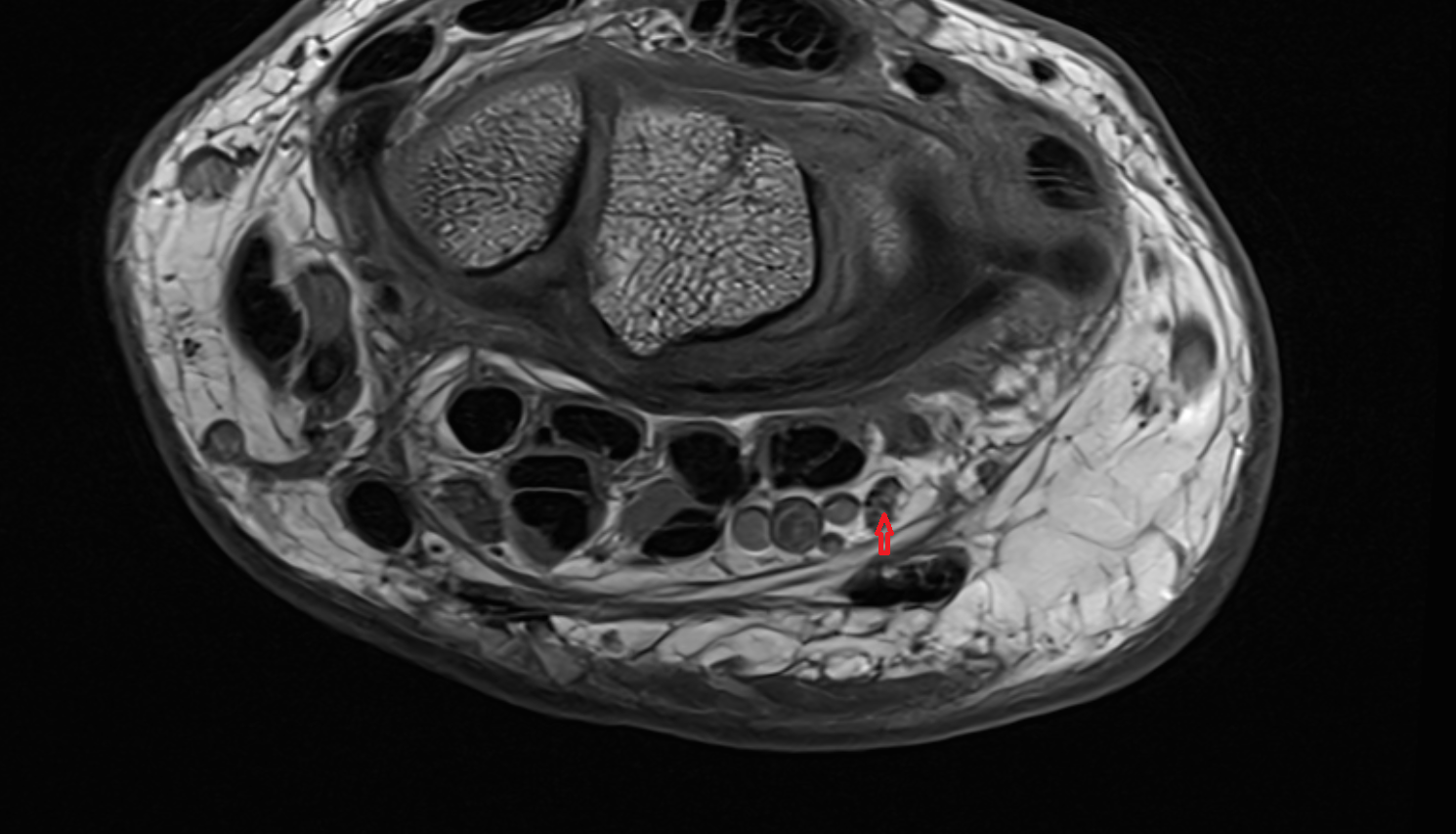 Ulnar nerve axial wrist cross sectional anatomy 3T MRI AI enhanced radiology image-img-00000-00000_00001