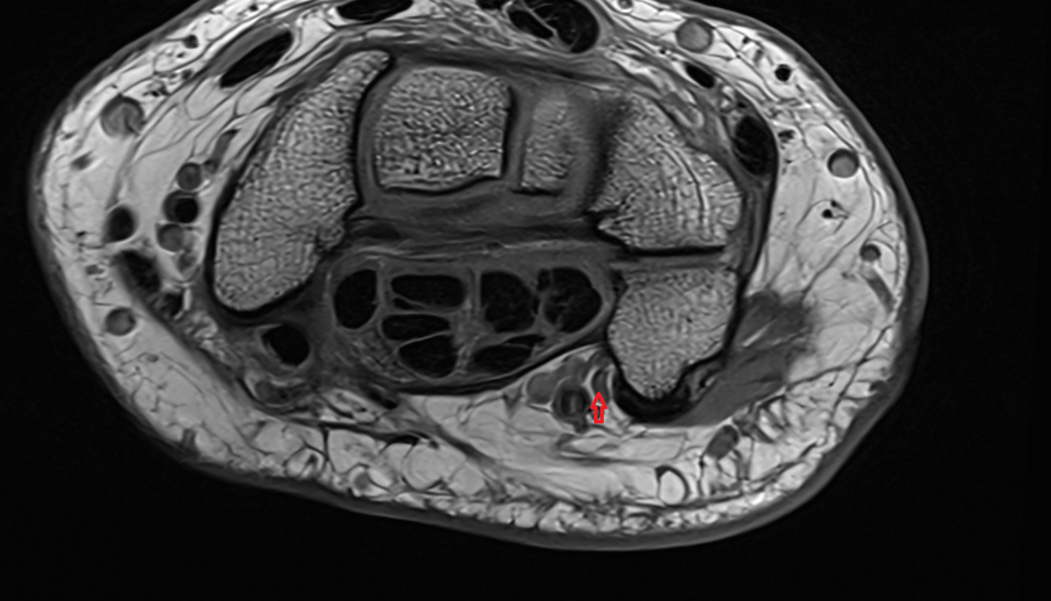 Ulnar nerve axial wrist cross sectional anatomy 3T MRI AI enhanced radiology image-img-00000-00000_00002