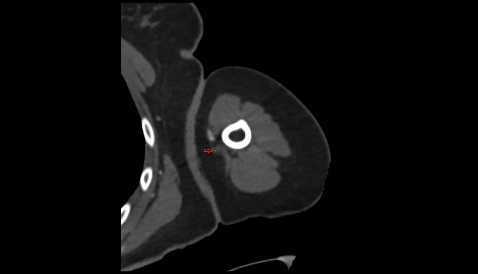 Ulnar nerve ct axial