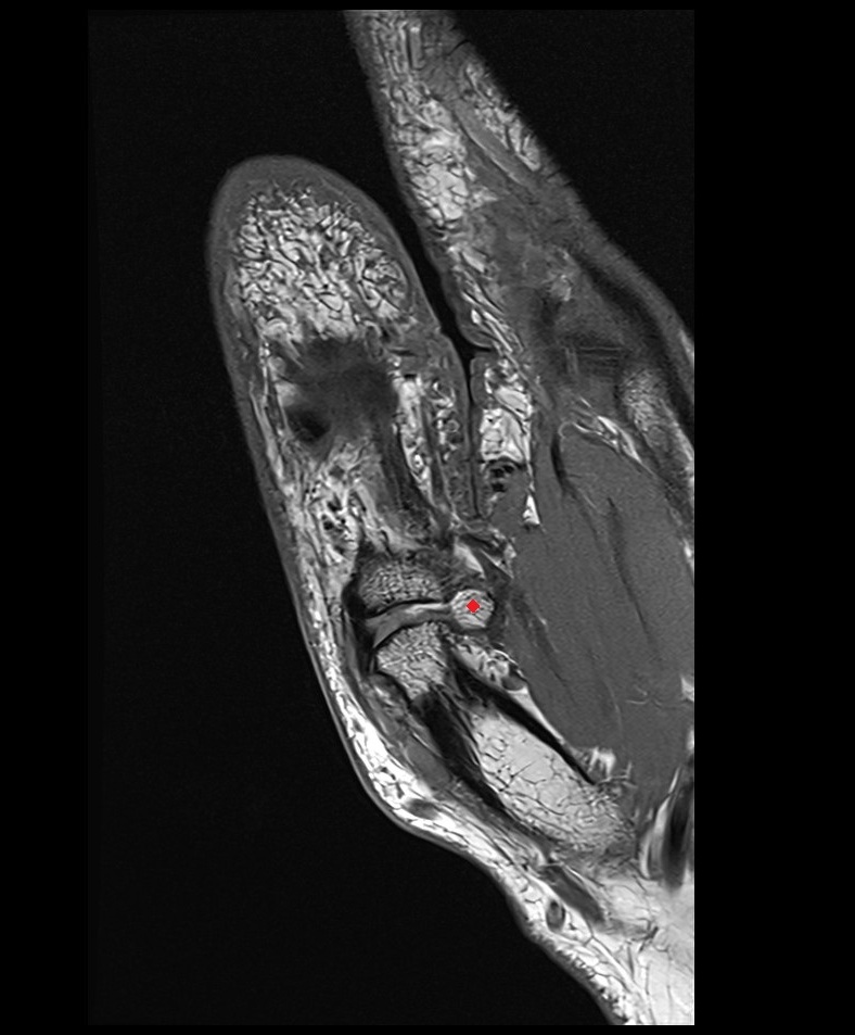 Ulnar sesamoid bone of thumb mri