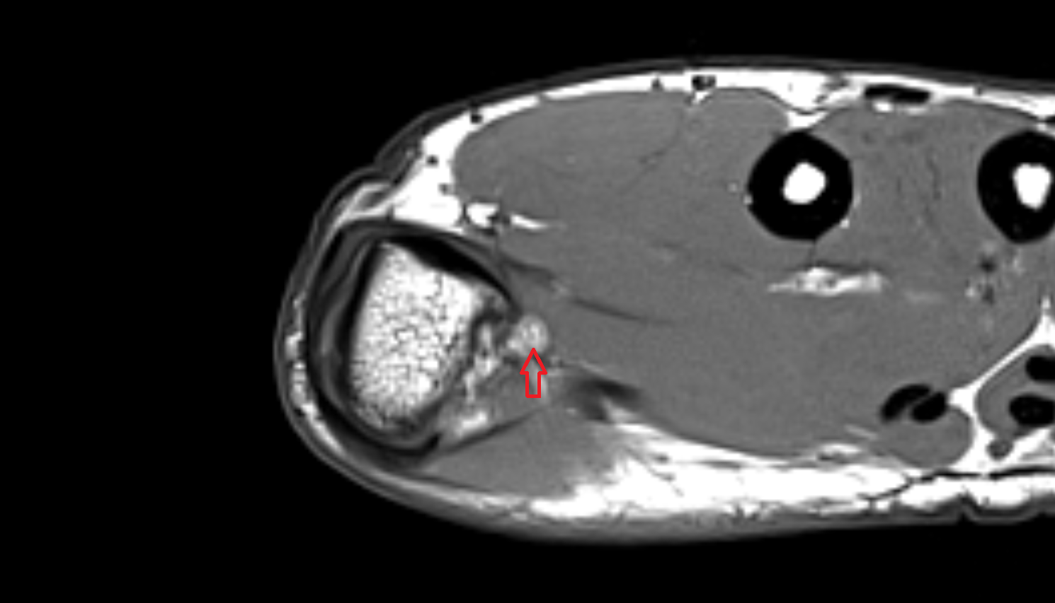 Ulnar sesamoid bone of thumb mri  anatomy labelled image-img-00000-00000