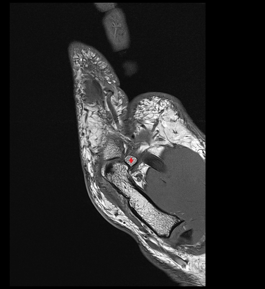 Ulnar sesamoid bone of thumb sag mri