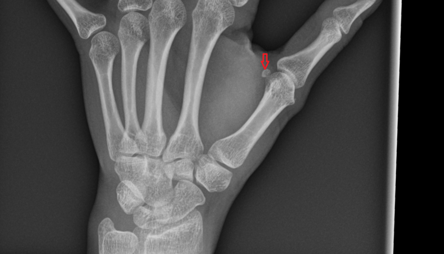 Ulnar sesamoid bone of thumb x ray  anatomy labelled image-img-00000-00000