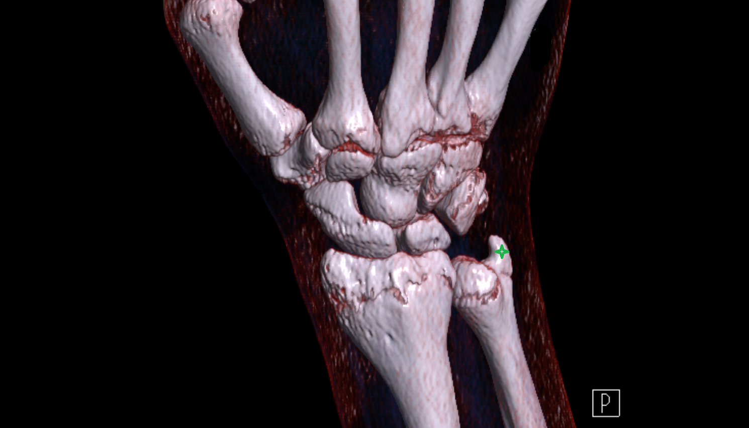 Ulnar styloid process CT 3D VRT image -img-00000-00000