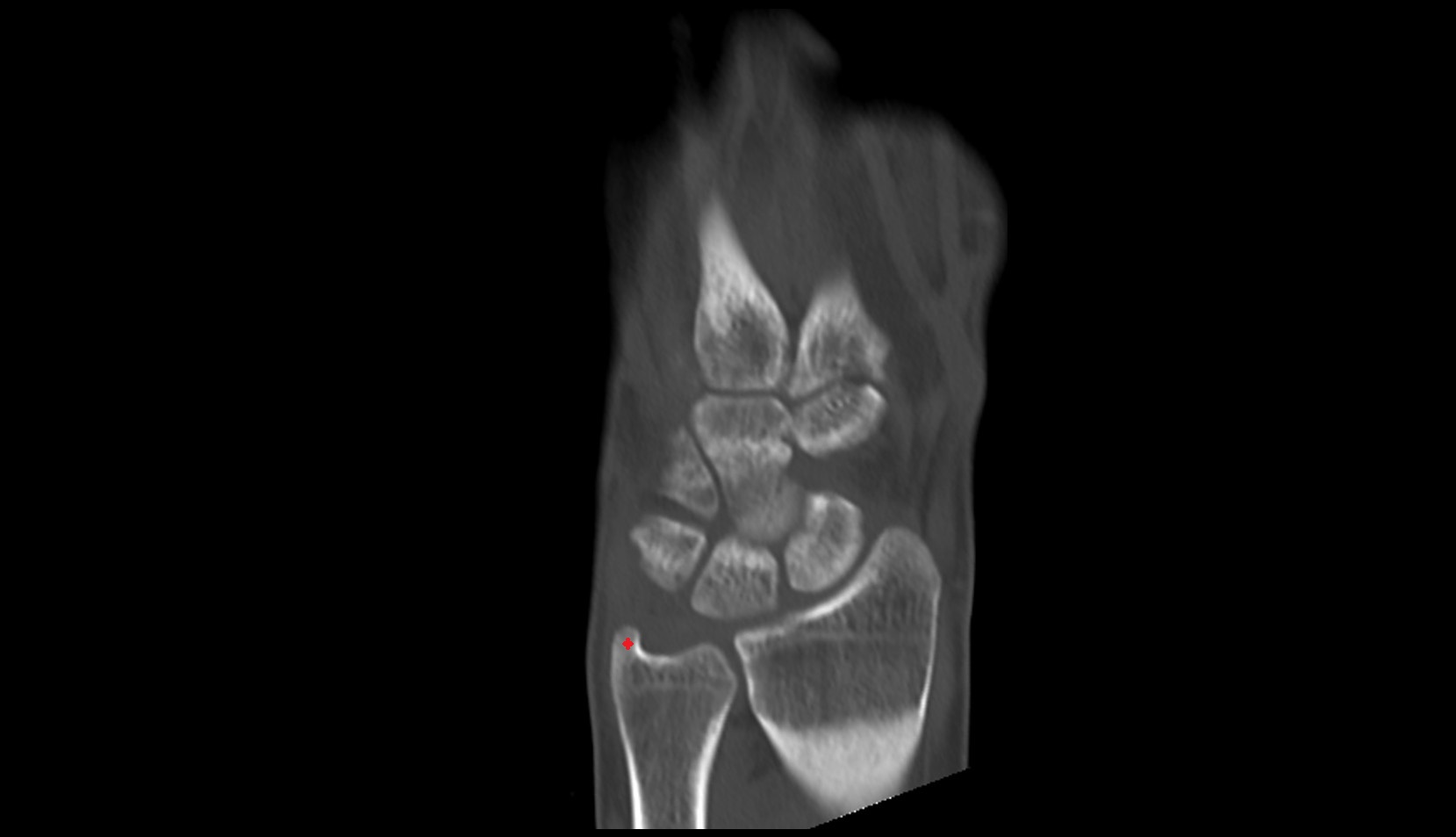 Ulnar styloid process ct coronal image
