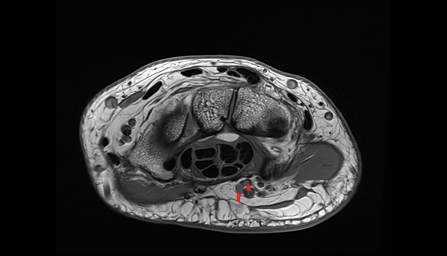 Ulnar veins  axial cross sectional anatomy 3T MRI AI enhanced radiology image -img-00000-00000