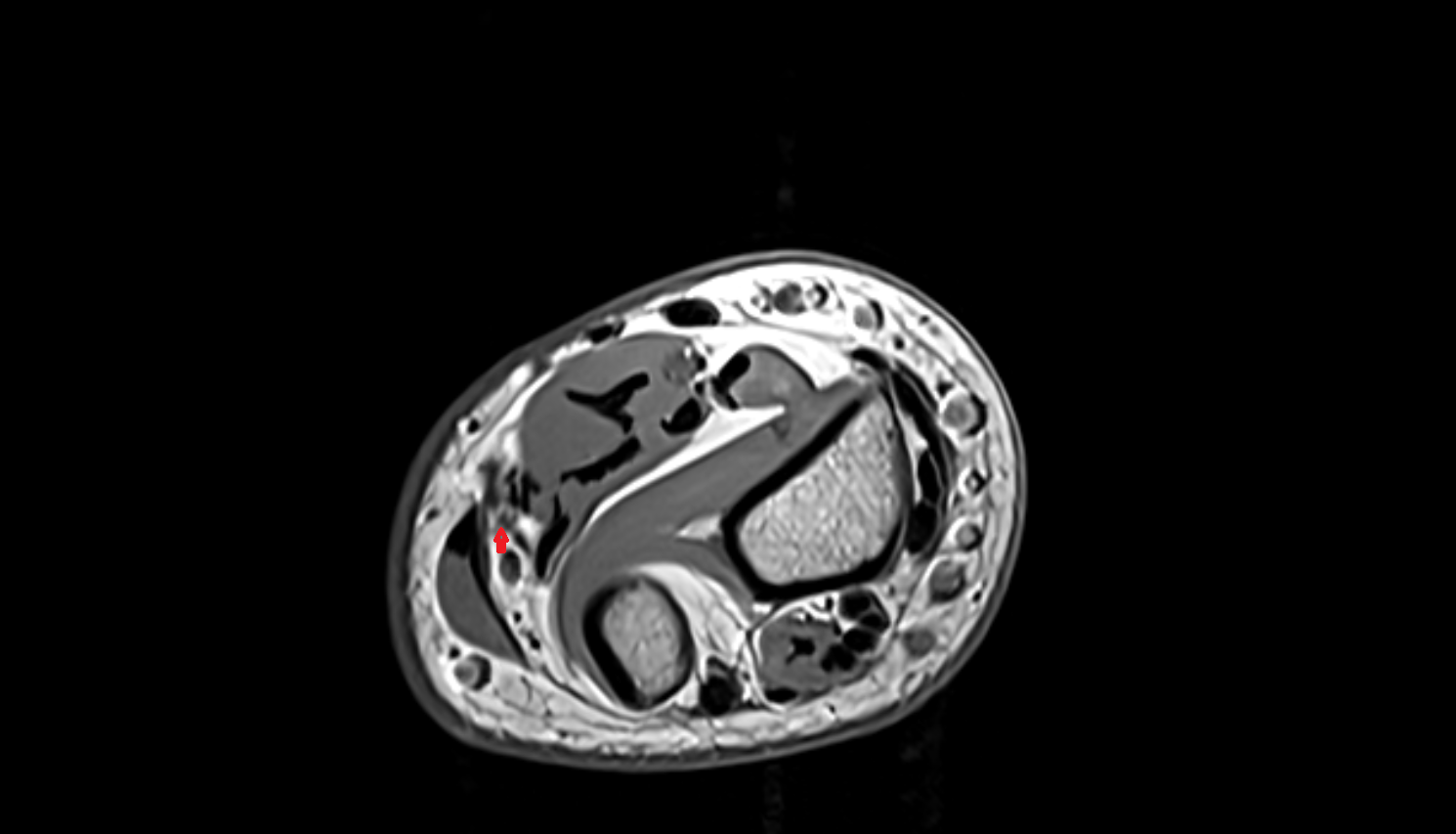 Ulnar veins  axial cross sectional anatomy 3T MRI AI enhanced radiology image -img-00000-00000_00003