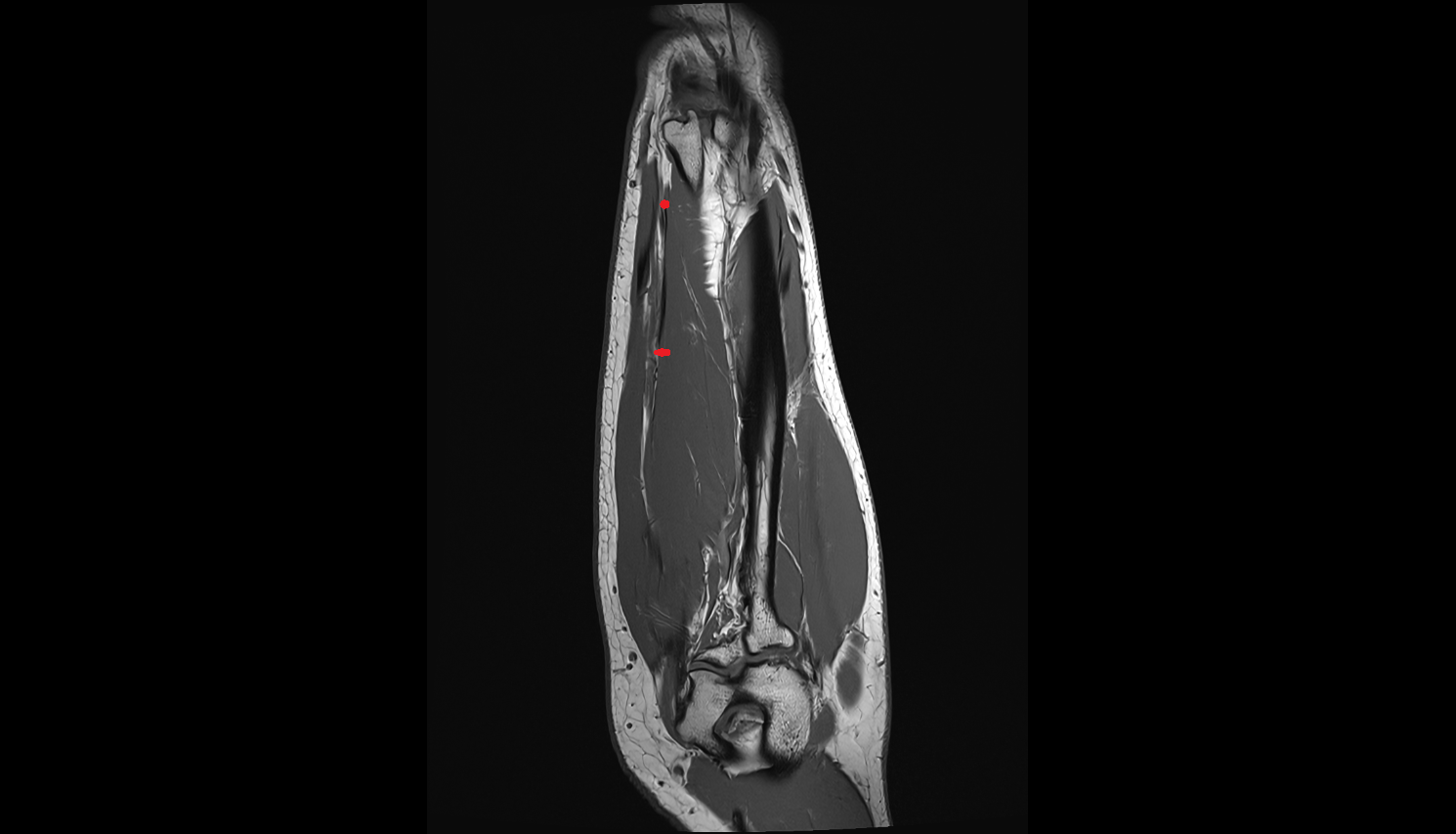 Ulnar veins  axial cross sectional anatomy 3T MRI AI enhanced radiology image -img-00000-00000_00005
