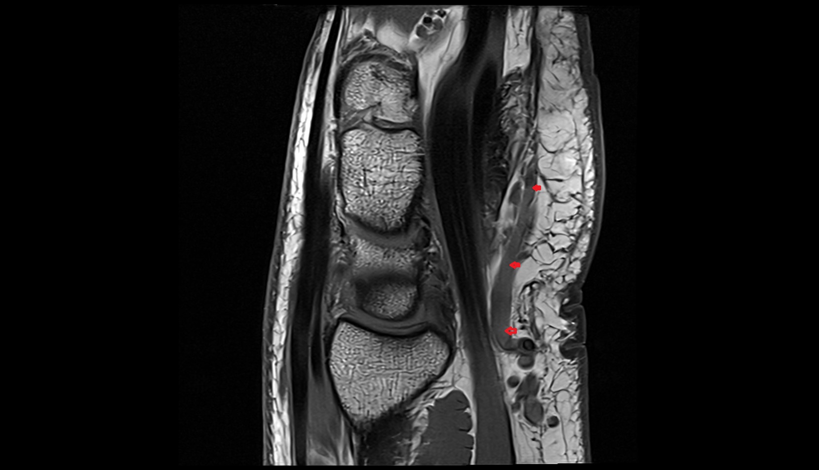 Ulnar veins sagittal mri images