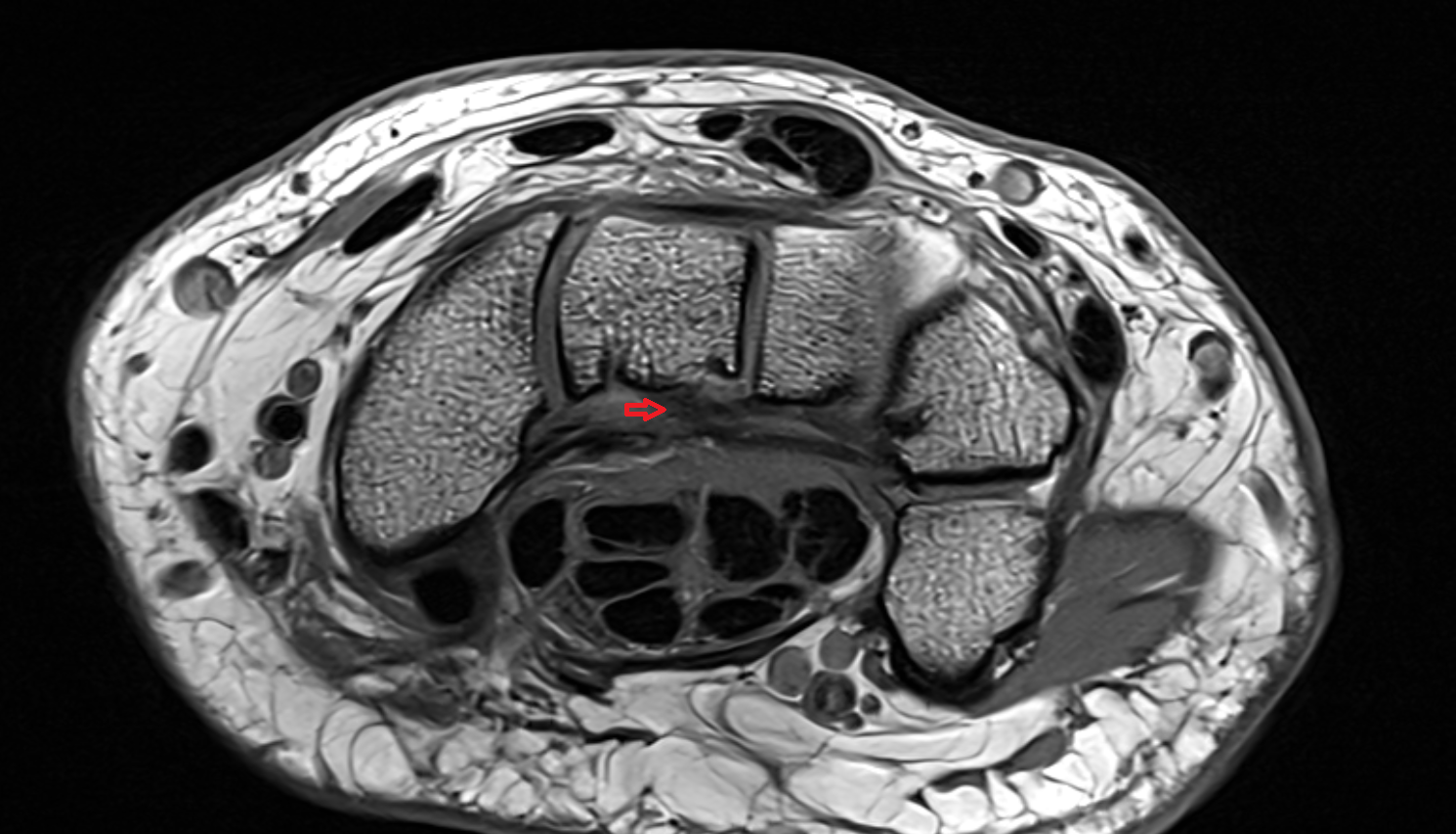 Ulnocapitate ligament  axial cross sectional anatomy 3T MRI AI enhanced radiology image-img-00000-00000