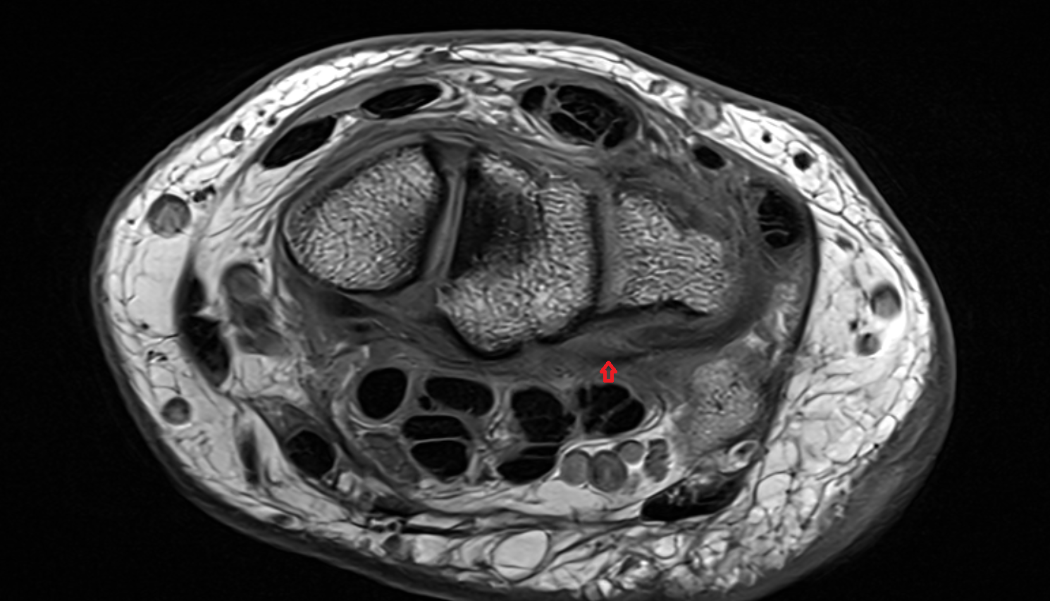 Ulnocapitate ligament  axial cross sectional anatomy 3T MRI AI enhanced radiology image-img-00000-00000_00002